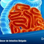 Diagnóstico do Câncer de Intestino Delgado